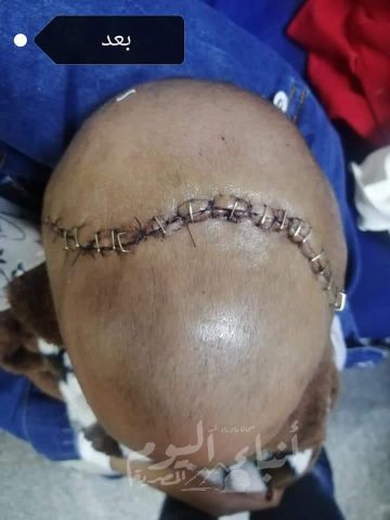 مستشفي سوهاج الجامعي تجري جراحة بمخ طفل لحمايته من فقدان البصر