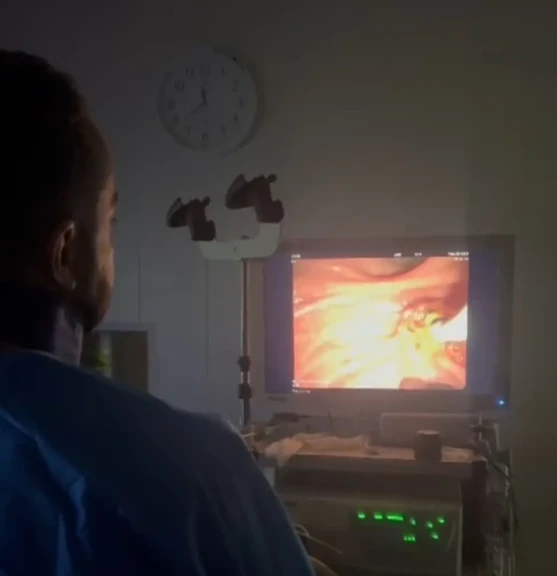 تدريسي في كلية طب المستنصرية ببغداد يجري عملية قسطرة القنوات الصفراوية واستخراج الأكياس المائية لمريضة