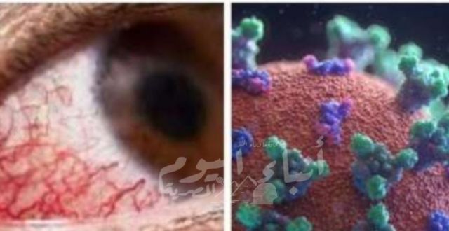 وكيل وزارة الصحة لشئون الطب الوقائي : الفطر الأسود ليس ميكروبًا جديدًا على مصر